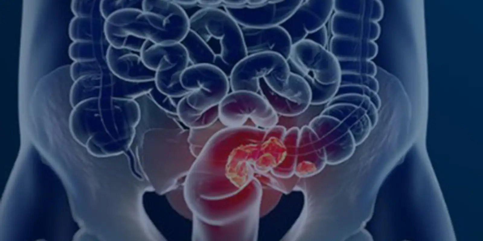 pacientes-com-cancer-colorretal-sao-diagnosticados-em-estagio-avancado